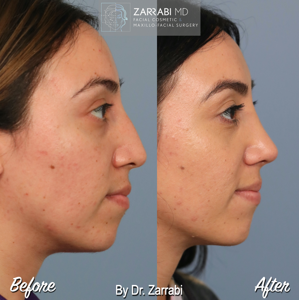 Closed Ultrasonic Rhinoplasty 3 3