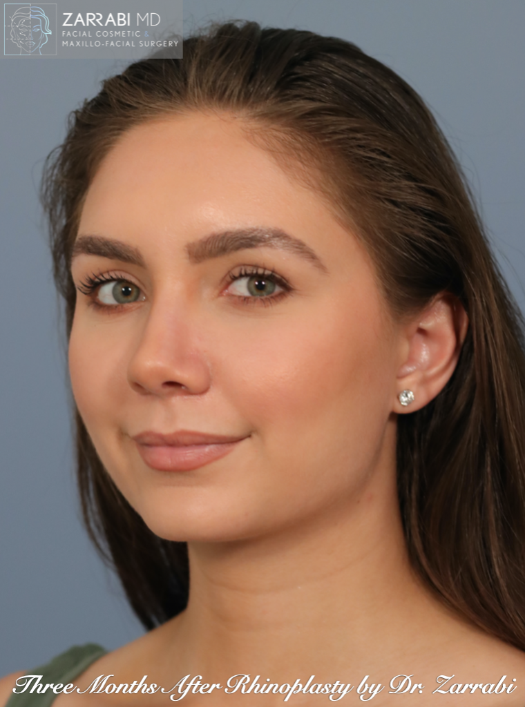 Closed Ultrasonic Rhinoplasty 3 4