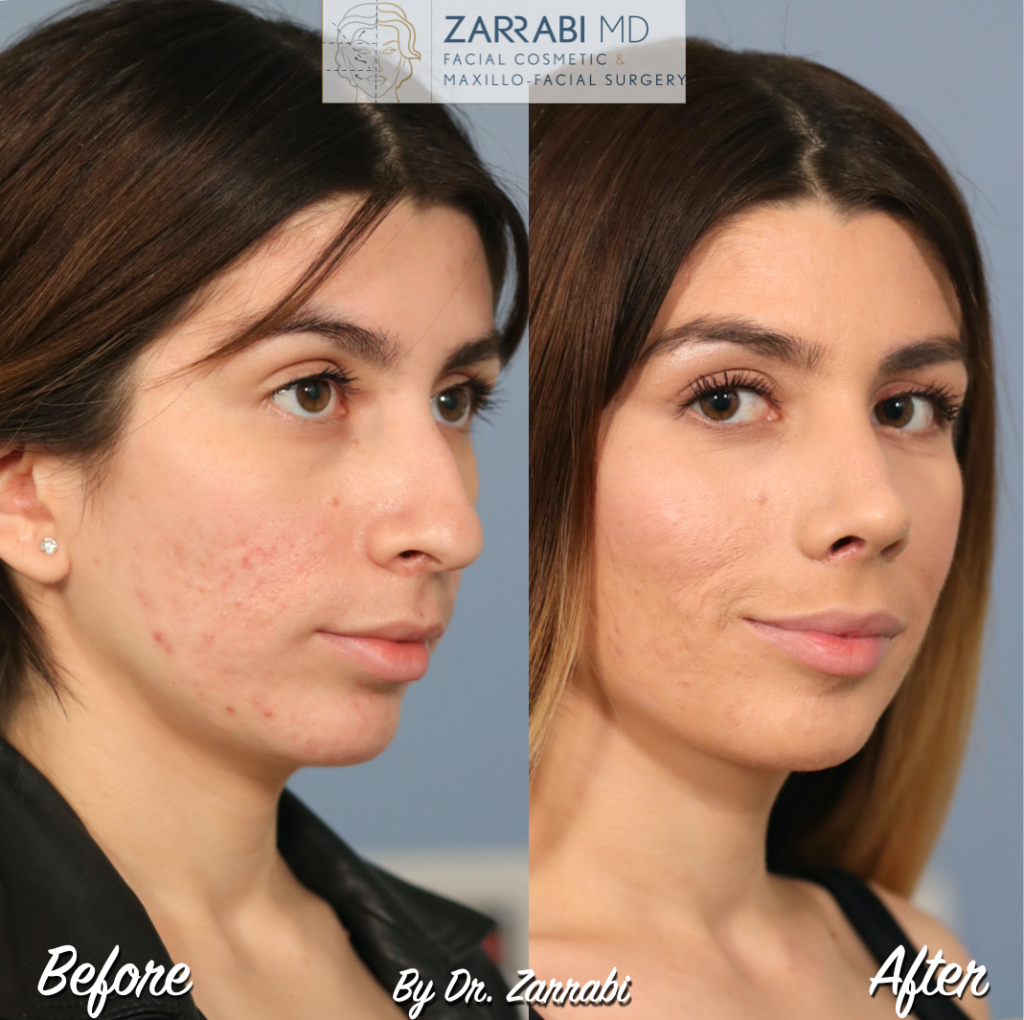 Closed Ultrasonic Rhinoplasty 3 6