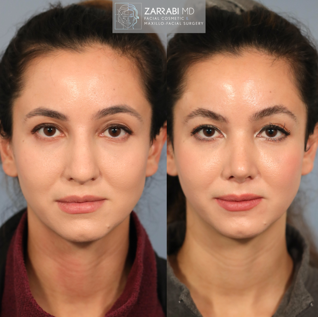 Closed Ultrasonic Rhinoplasty 3