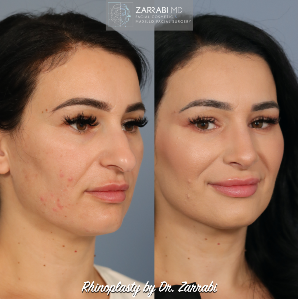 Closed Ultrasonic Rhinoplasty 4 1
