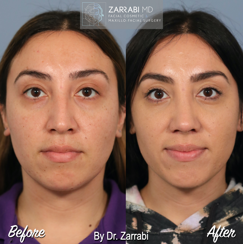 Closed Ultrasonic Rhinoplasty 4 3