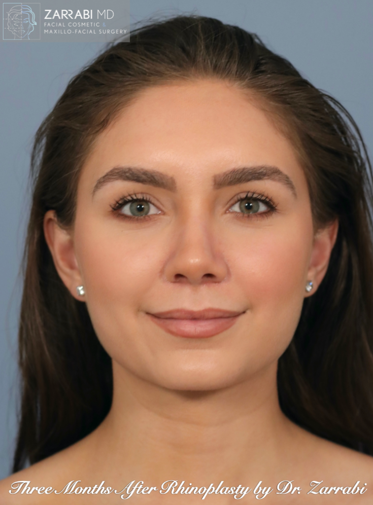 Closed Ultrasonic Rhinoplasty 4 4