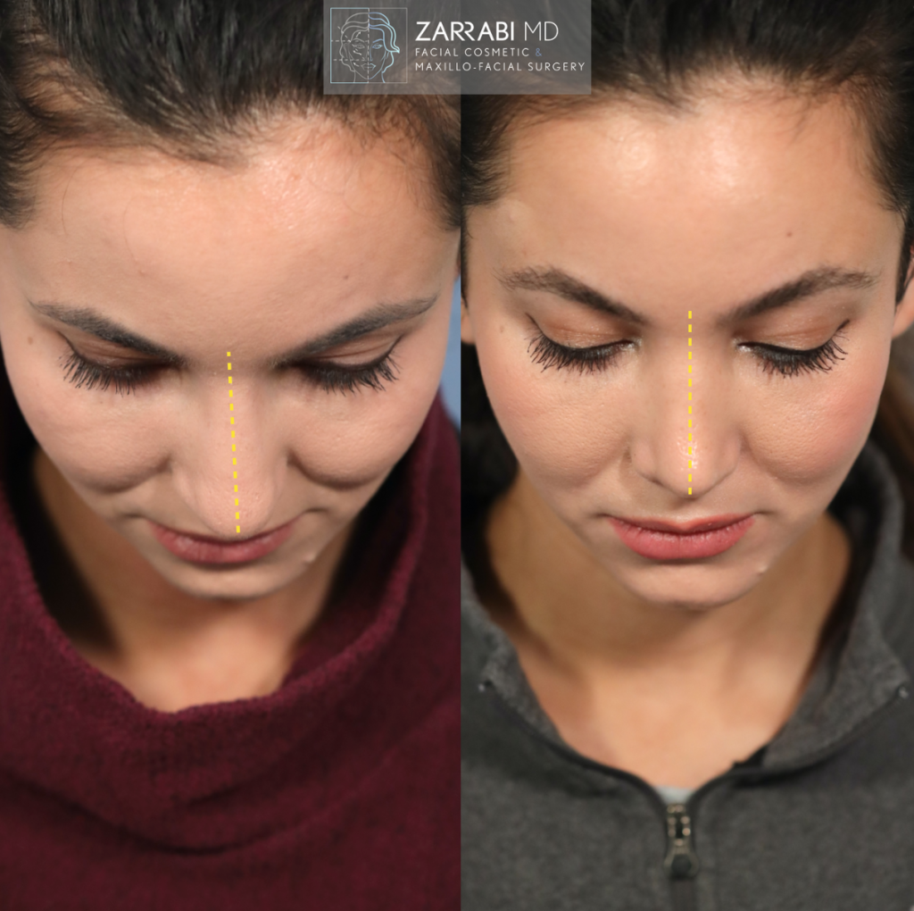 Closed Ultrasonic Rhinoplasty 4