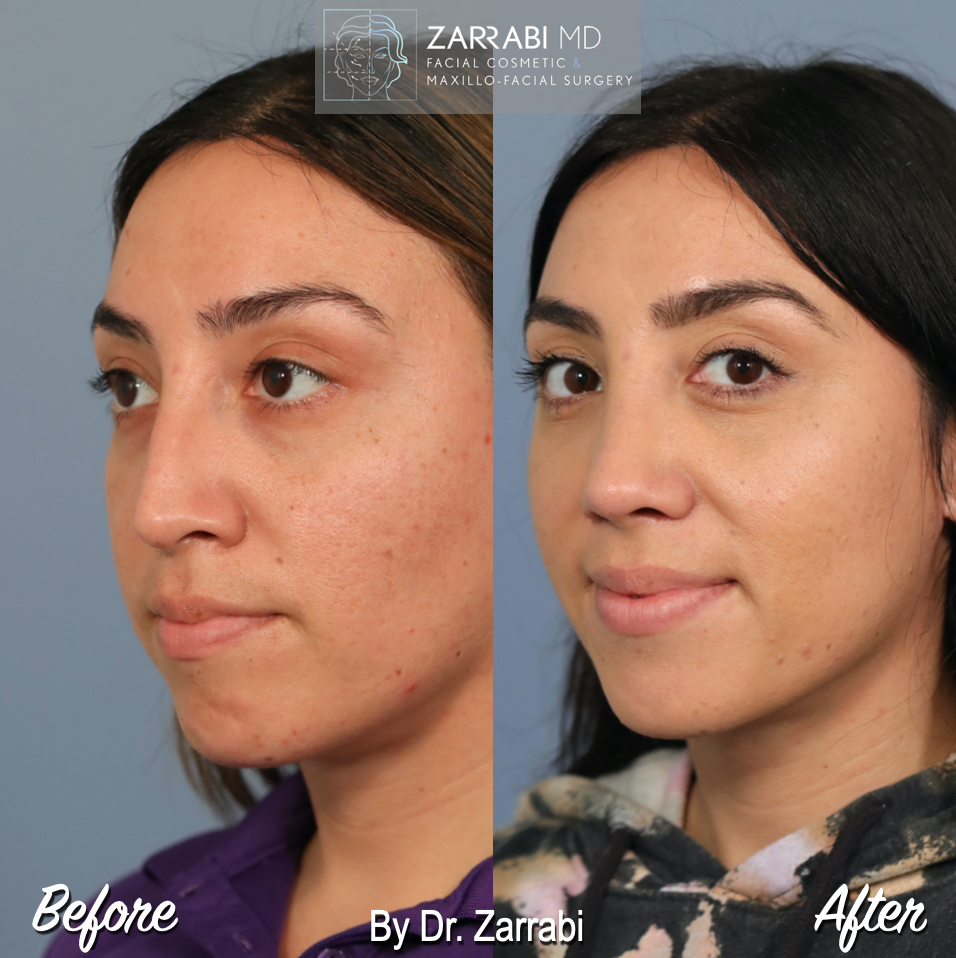 Closed Ultrasonic Rhinoplasty 5 3