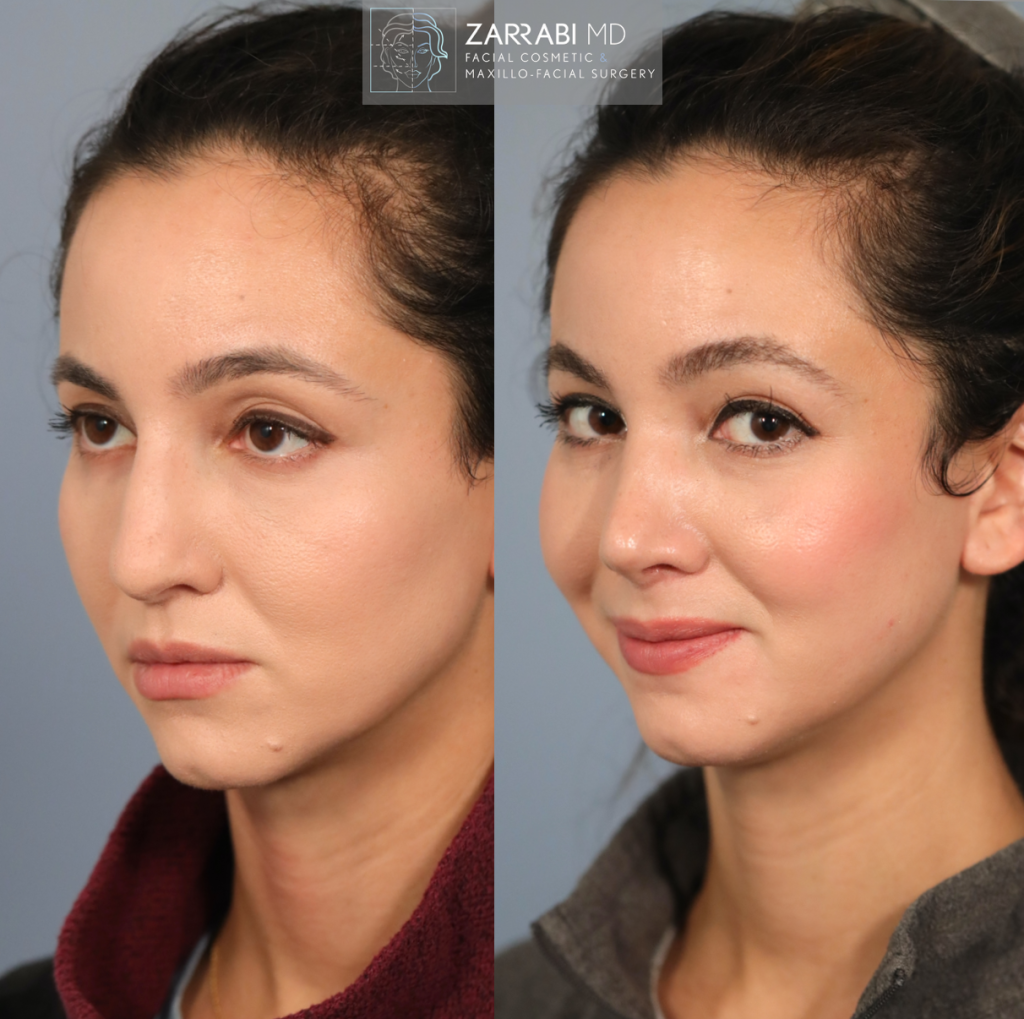 Closed Ultrasonic Rhinoplasty 5