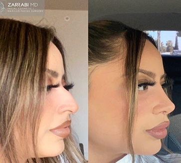 Piezo Rhinoplasty BA