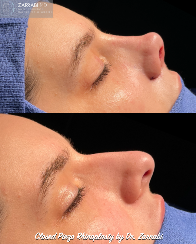 Piezo Ultrasonic Rhinoplasty 3 1