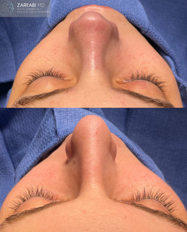 Piezo Ultrasonic Rhinoplasty 3 2