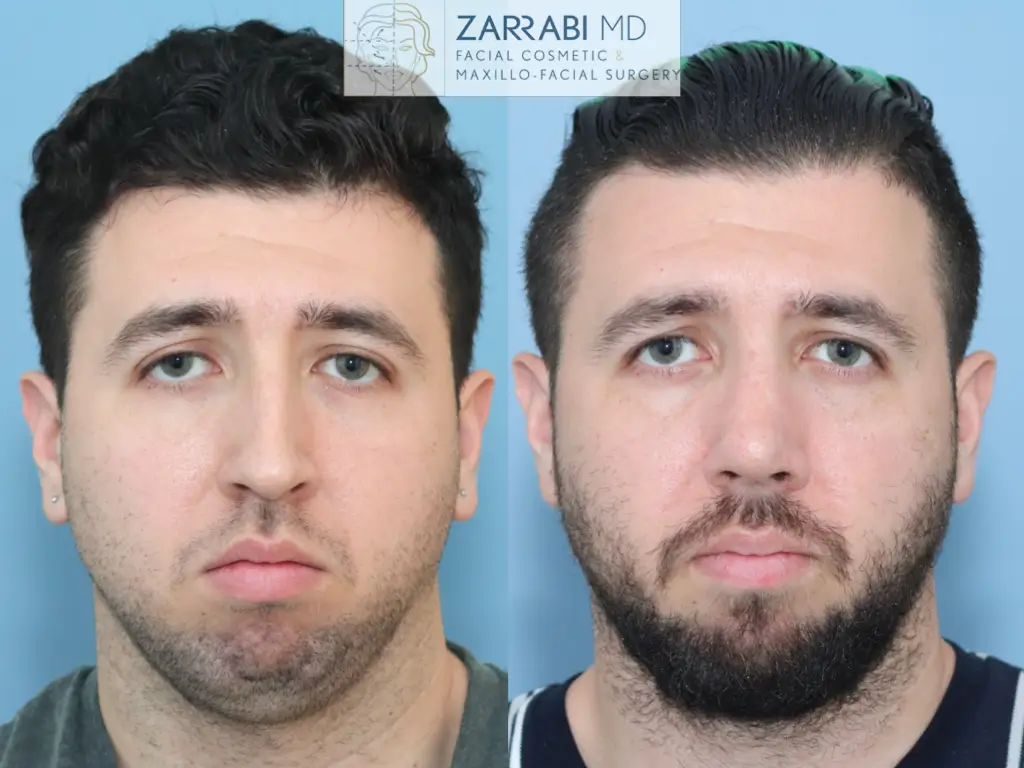 Preservation-Rhinoplasty-2