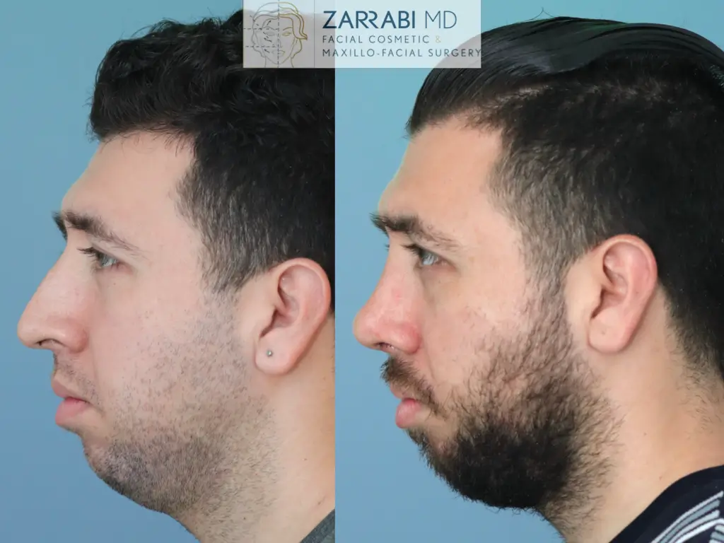 Preservation-Rhinoplasty-3