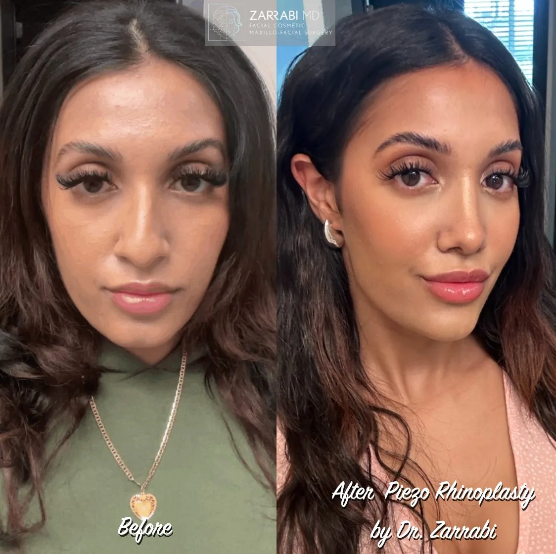 Front-facing before and after piezo rhinoplasty by Dr. Zarrabi showing facial refinement