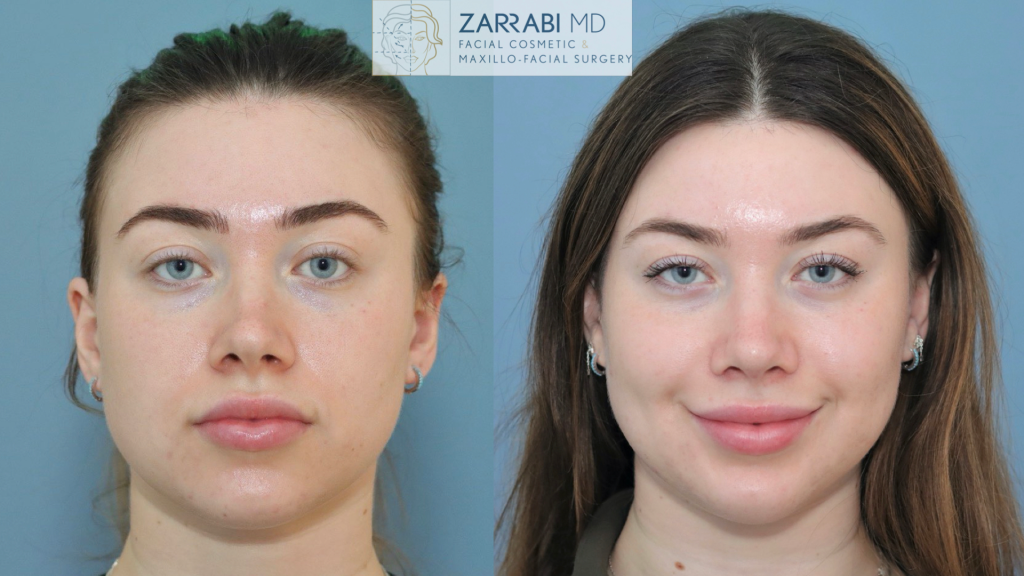 Rhinoplasty 1 1