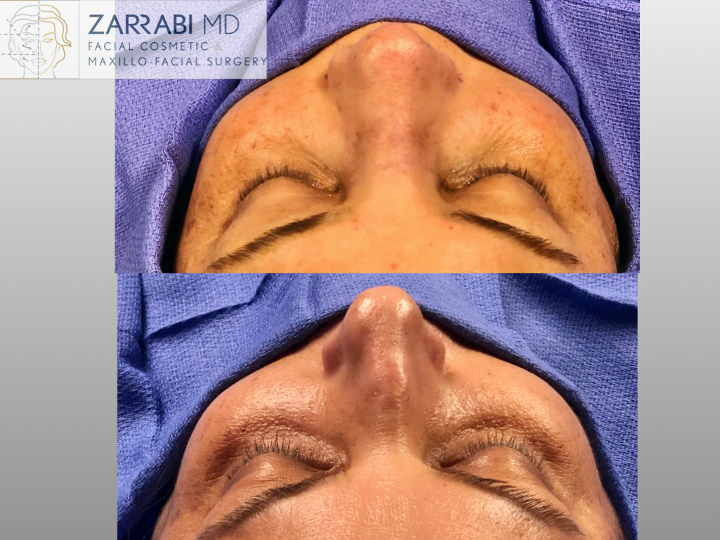 Rhinoplasty 1 2