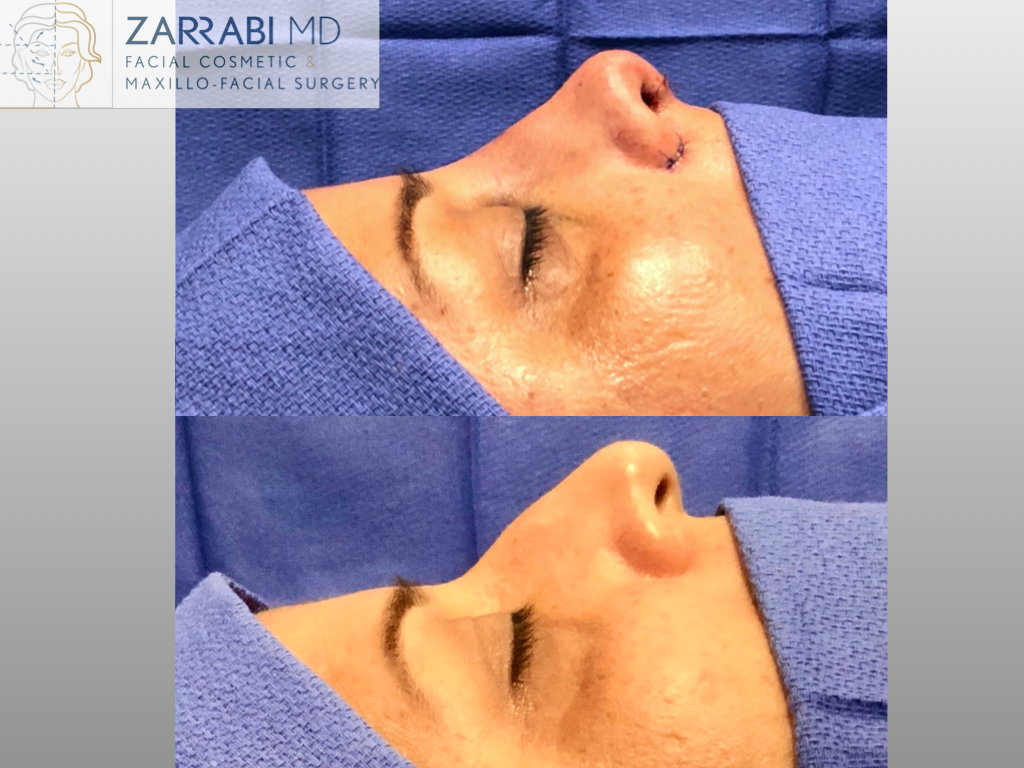 Rhinoplasty 2 1