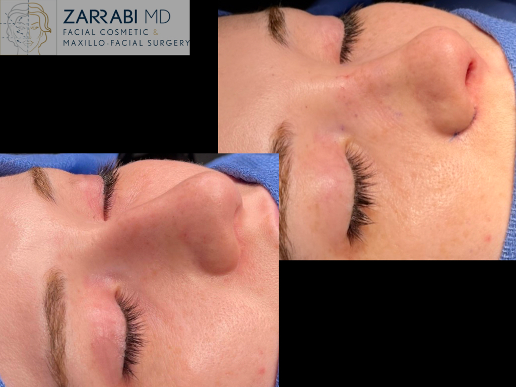 Rhinoplasty 2