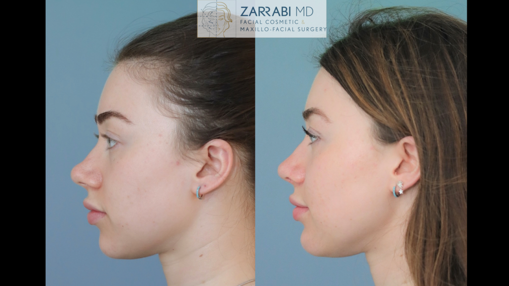 Rhinoplasty 5