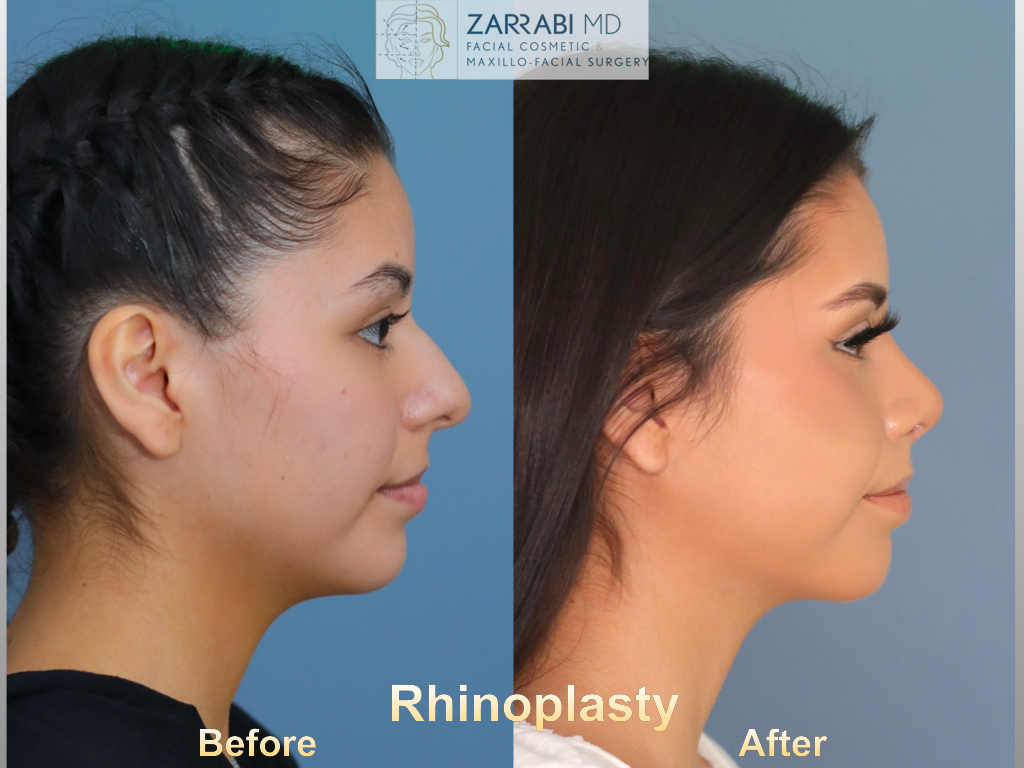 Rhinoplasty 6 weeks Post op 1