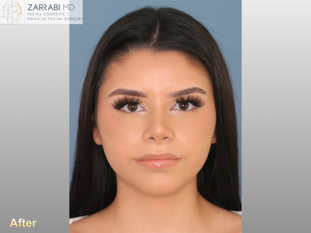 Rhinoplasty 6 weeks Post op 2