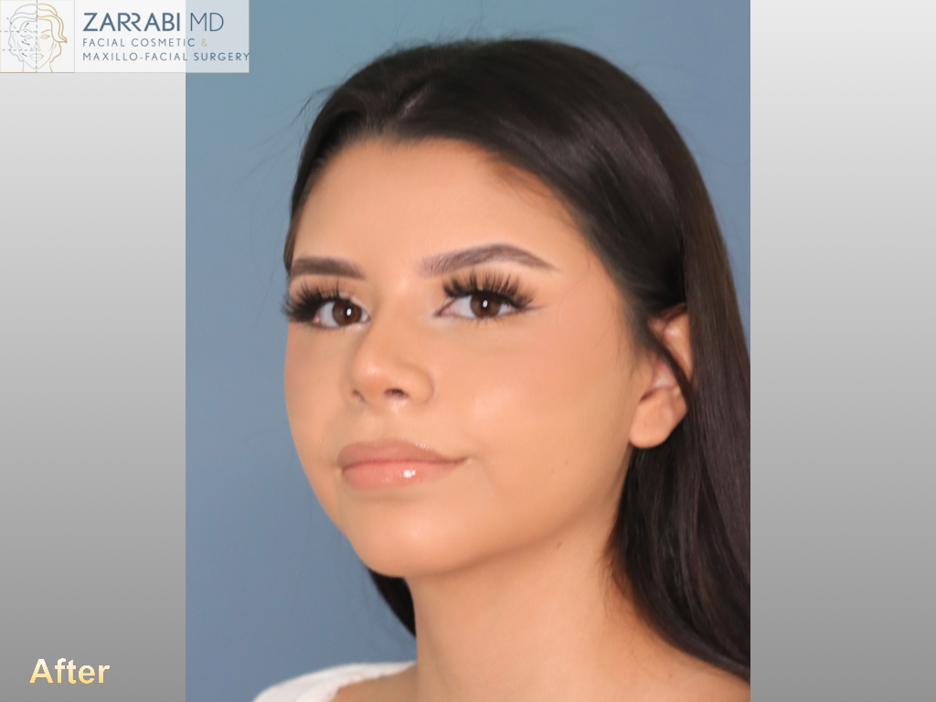 Rhinoplasty 6 weeks Post op 3