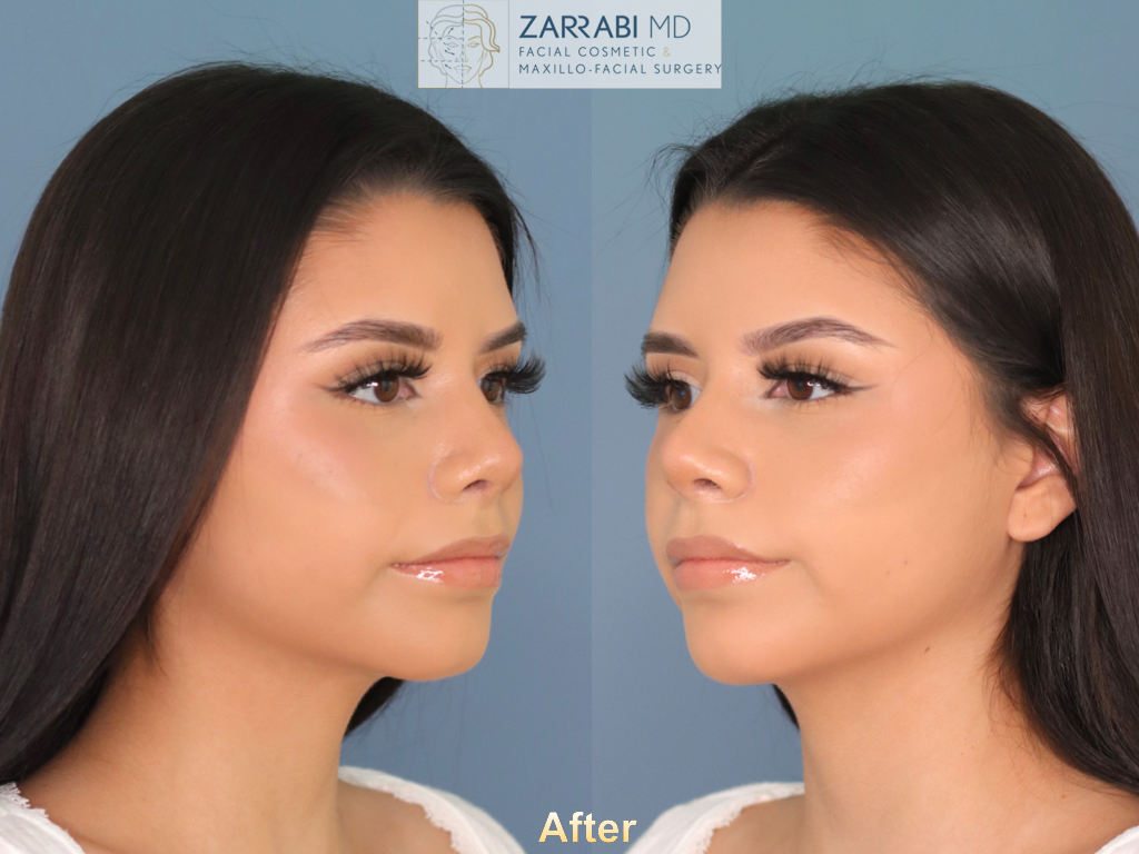 Rhinoplasty 6 weeks Post op 5
