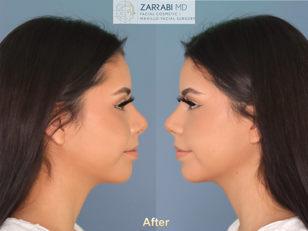 Rhinoplasty 6 weeks Post op 6