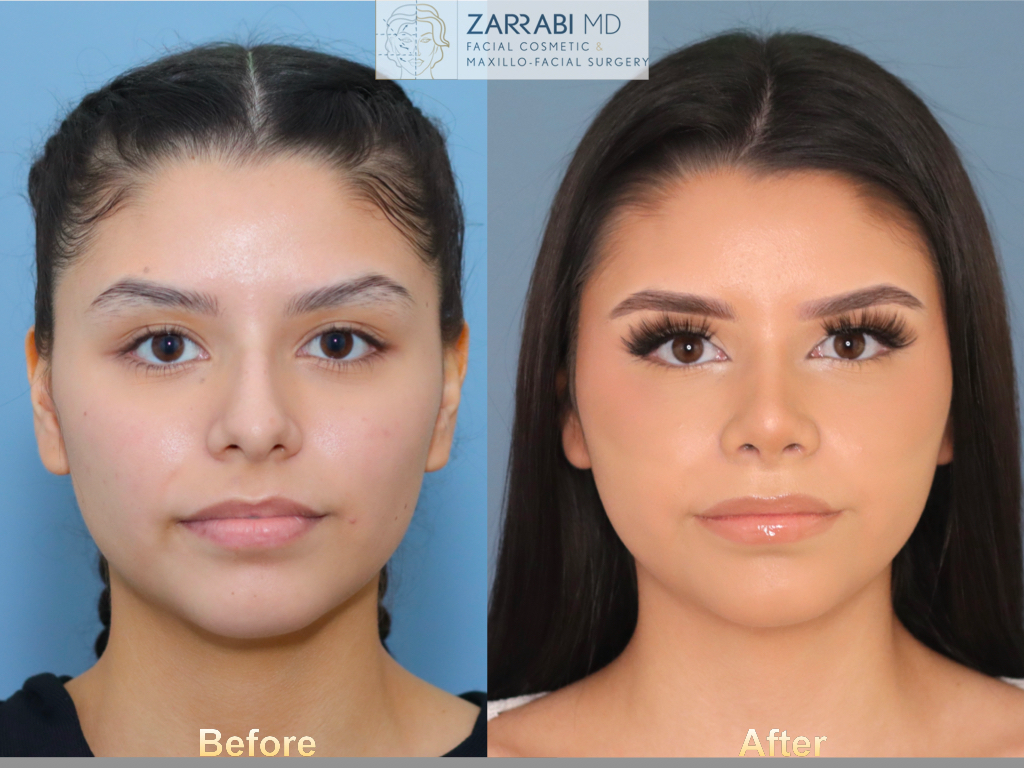 Rhinoplasty 6 weeks Post op 8