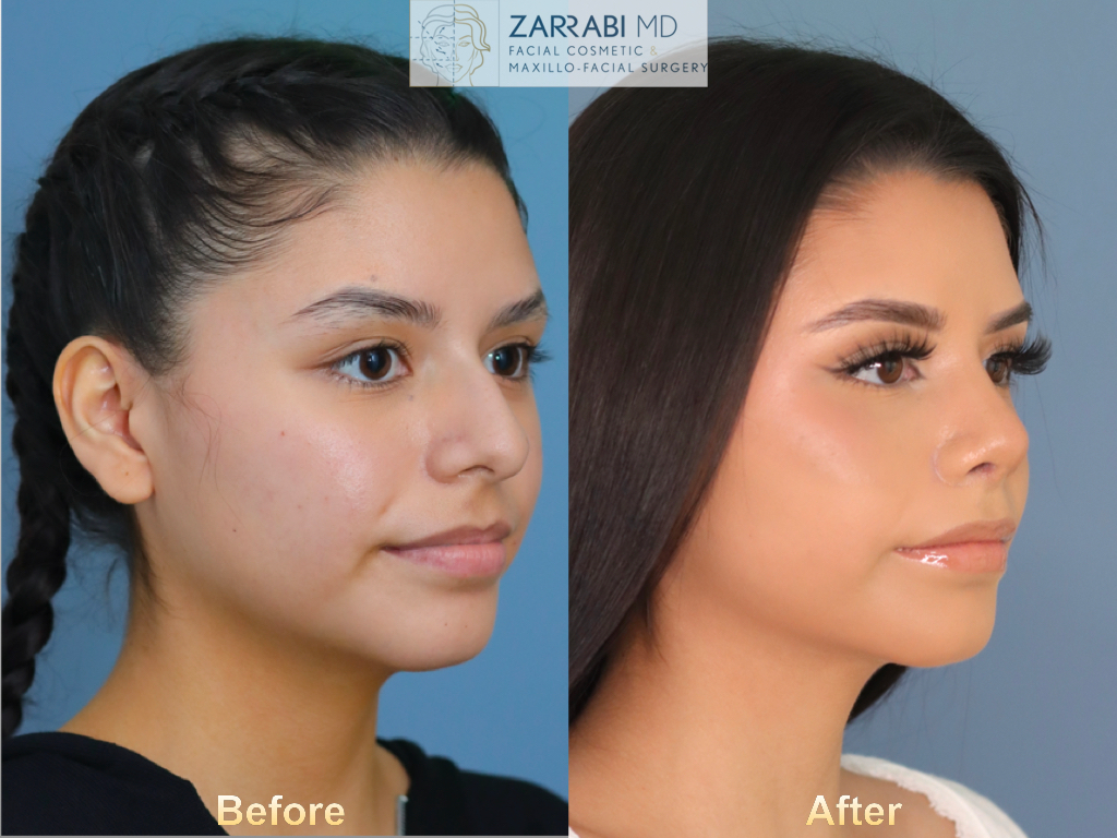 Rhinoplasty 6 weeks Post op 9