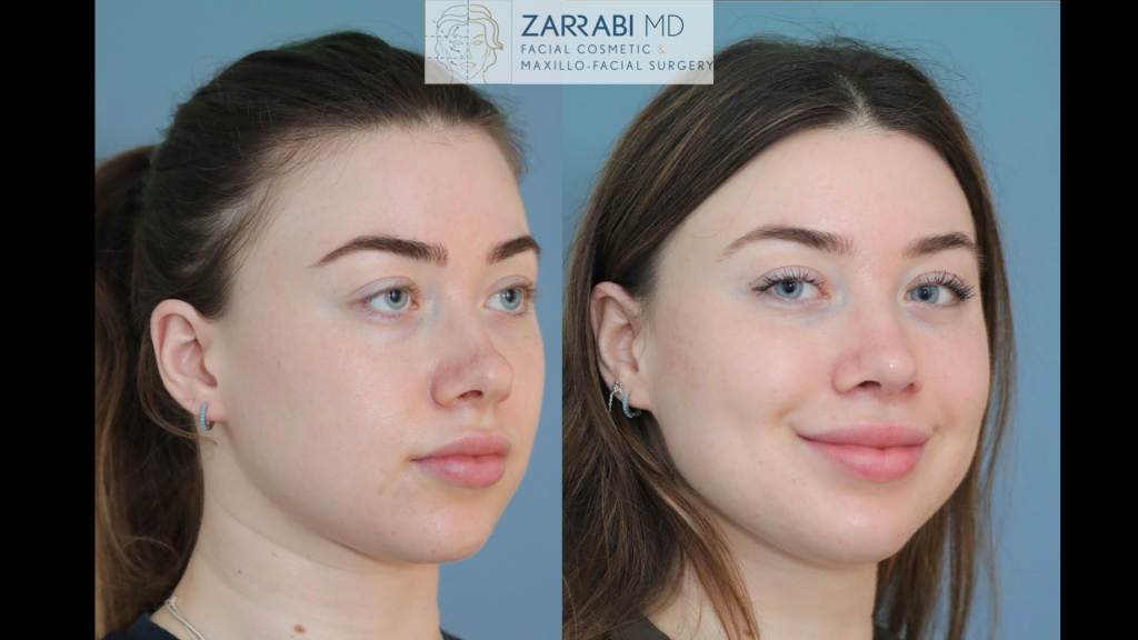 Rhinoplasty 6