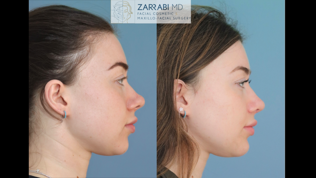 Rhinoplasty 7