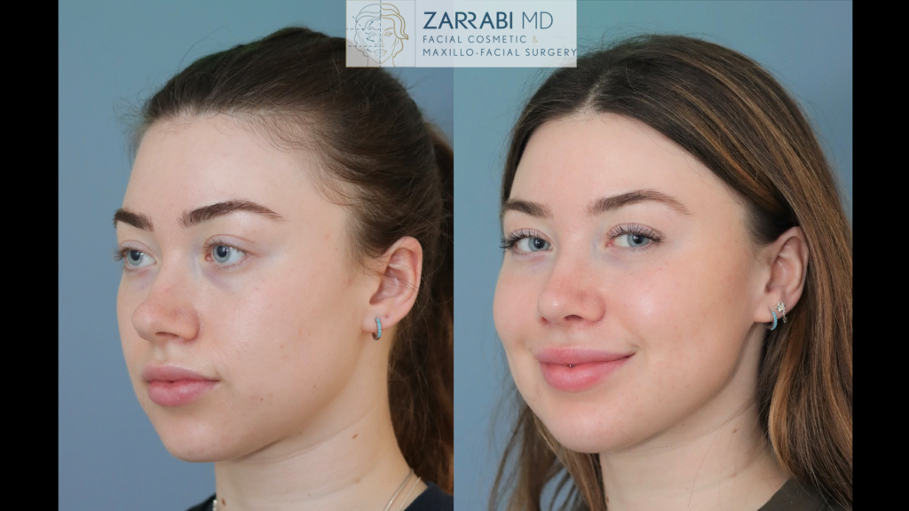 Rhinoplasty 8