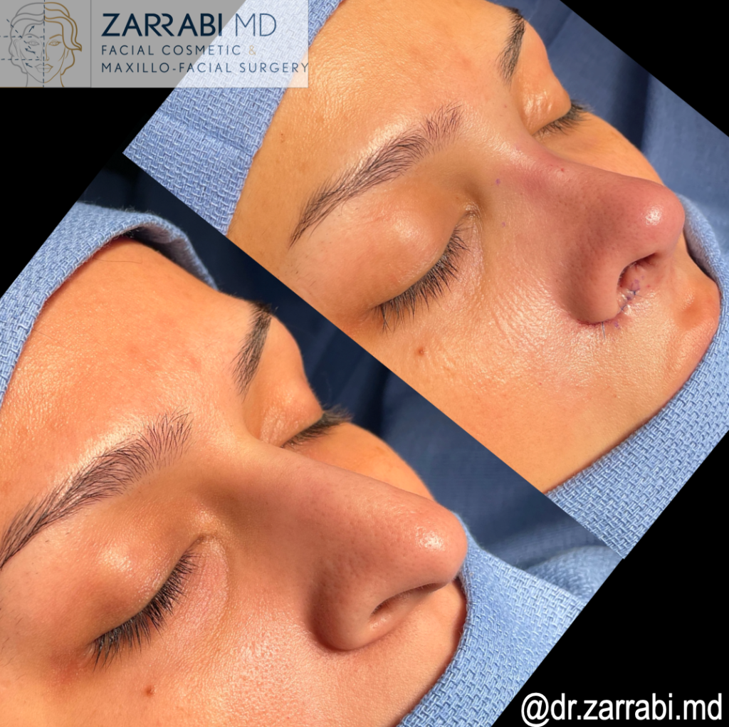 Rhinoplasty Before After 2 1