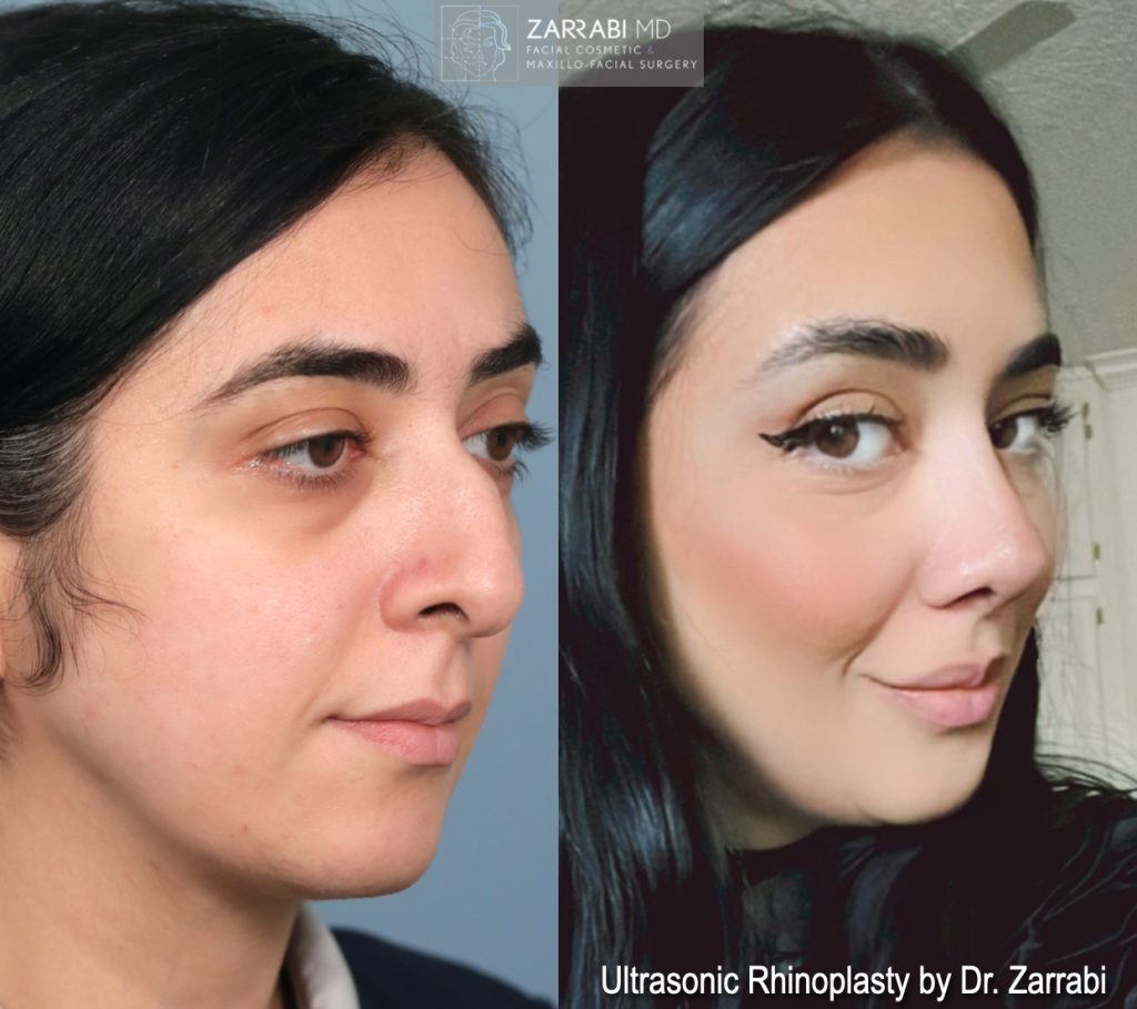 Ultrasonic Piezo Rhinoplasty