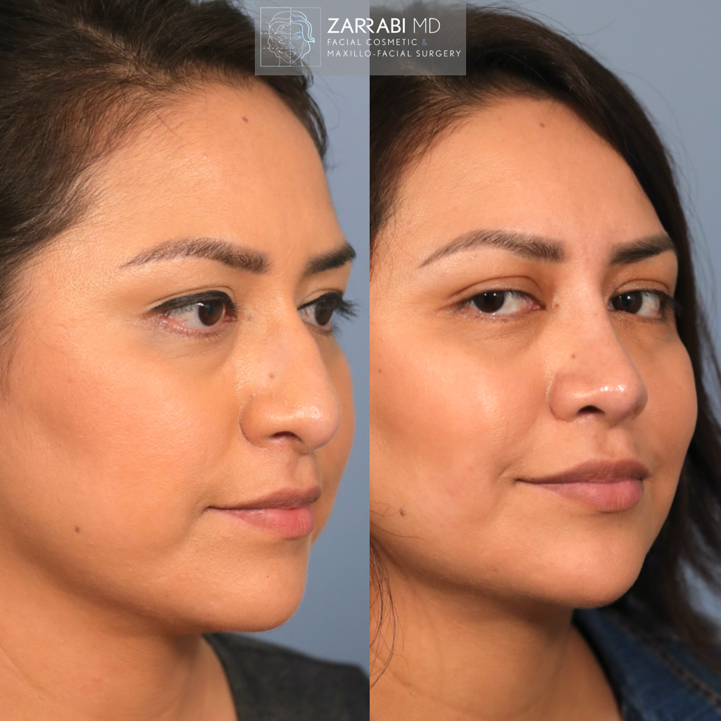Ultrasonic Rhinoplasty 5 1