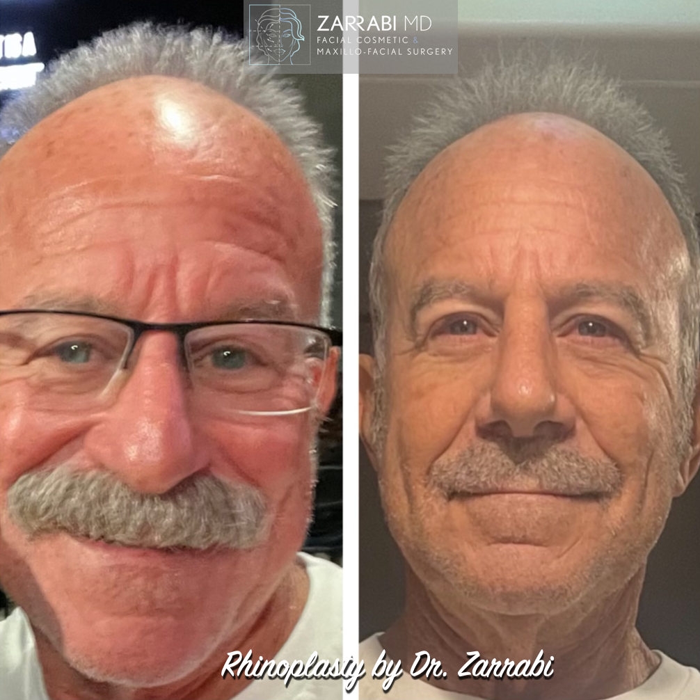 Ultrasonic Rhinoplasty