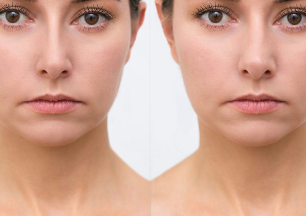 Crooked Nose Rhinoplasty Before & After Banner