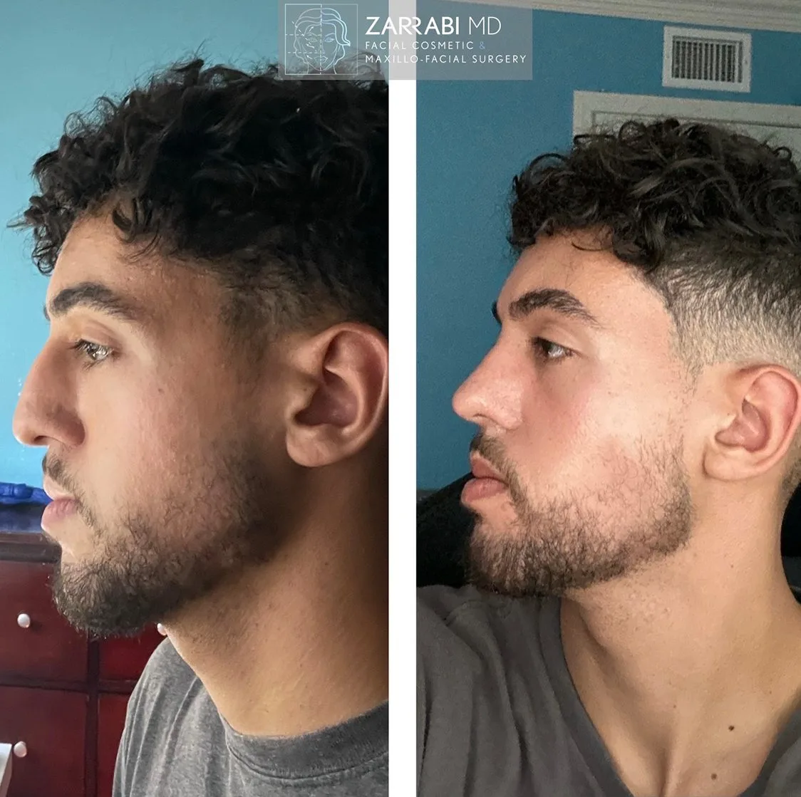 Side profile before and after comparison of patient showing facial structure changes