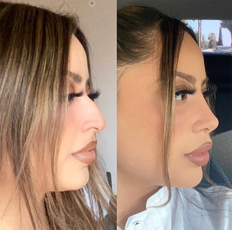 Side-by-side before and after rhinoplasty results showing profile view