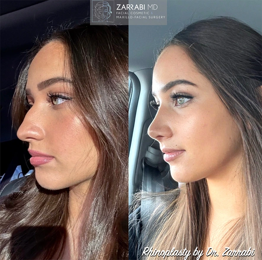Side-by-side before and after rhinoplasty results by Dr. Zarrabi